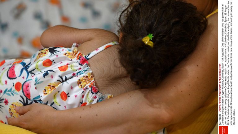 Children have been left with the condition 'werewolf syndrome' after taking the syrup