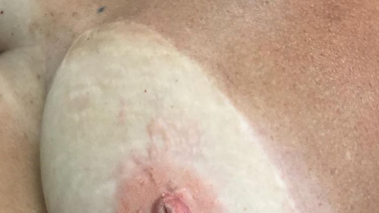 The skin is damaged from treatment and is harder to tattoo on than other types of skin. Pic: Terri Benamore