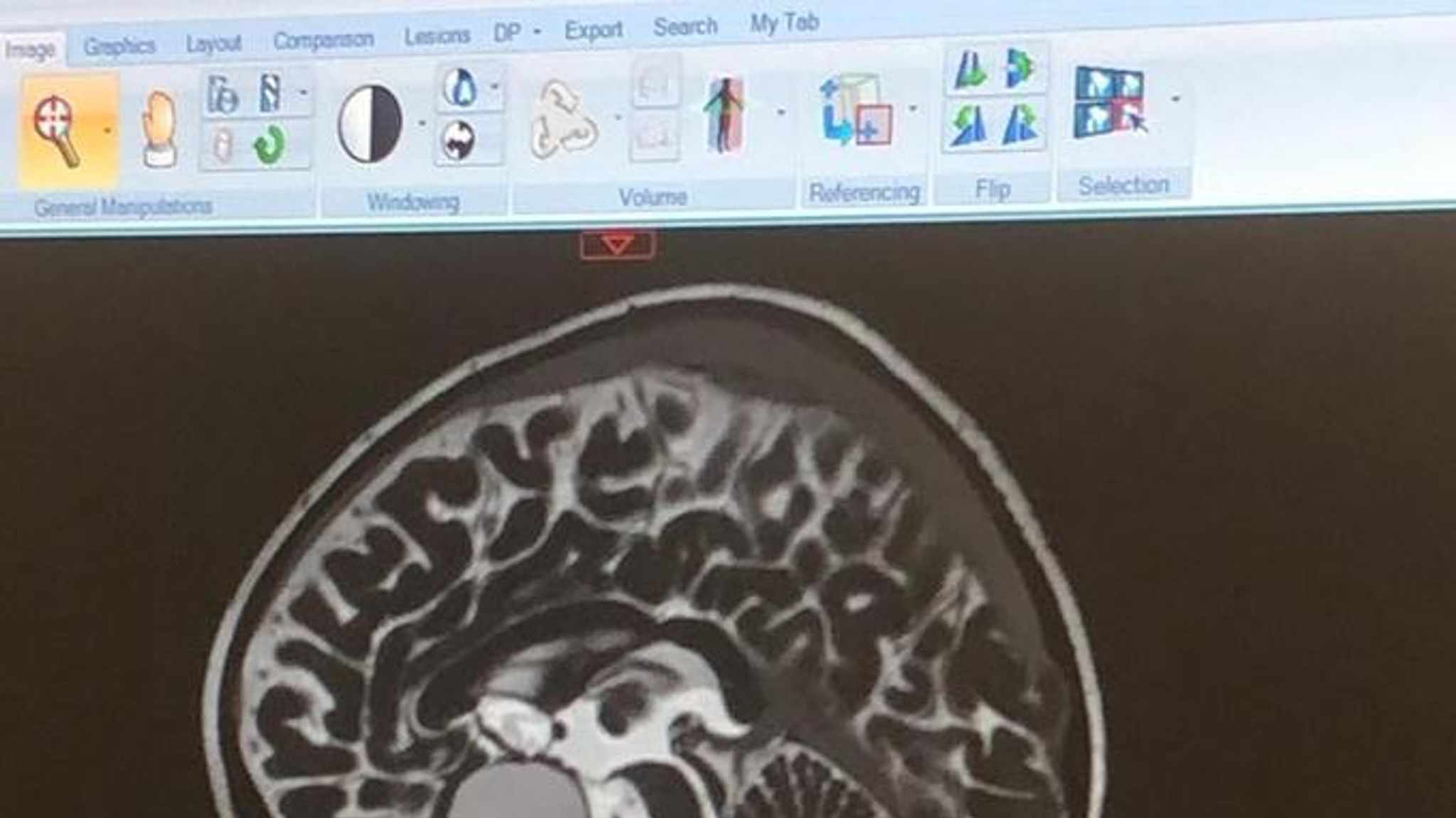 Toddler saved by eye test after optometrist spots rare brain tumour