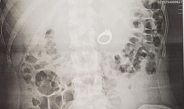 Woman dreams of swallowing engagement ring and wakes up to find she has