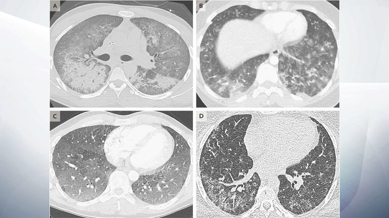 Scans of the lungs of four patients, aged 19 to 49, showing damage to the lungs from vaping devices. Pic: New England Journal of Medicine