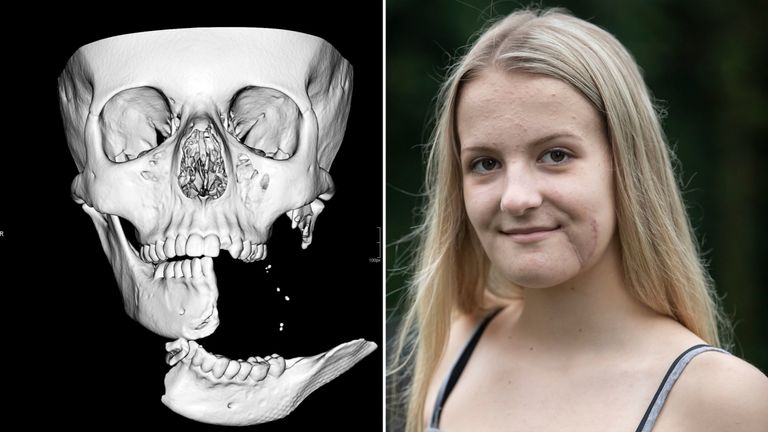 Girls Jaw Hung By 1cm Of Skin After Horse Riding Accident Uk News