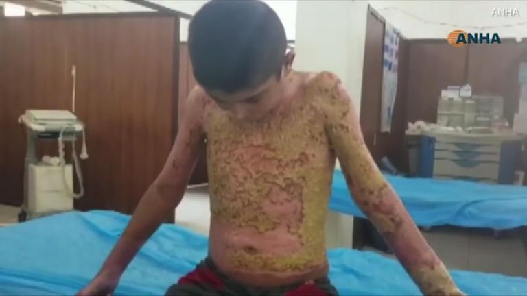Images have emerged showing badly burned children in Syria,  amid claims that Turkey is using banned chemical weapons against the Kurds. 