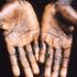 Two cases of monkeypox virus found in Wales