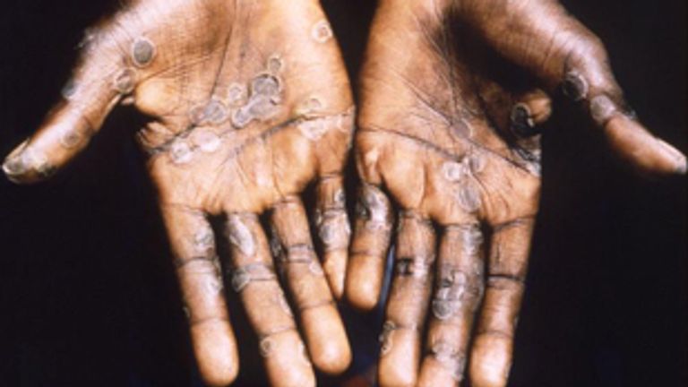 Two cases of monkeypox virus found in Wales | UK News | Sky News