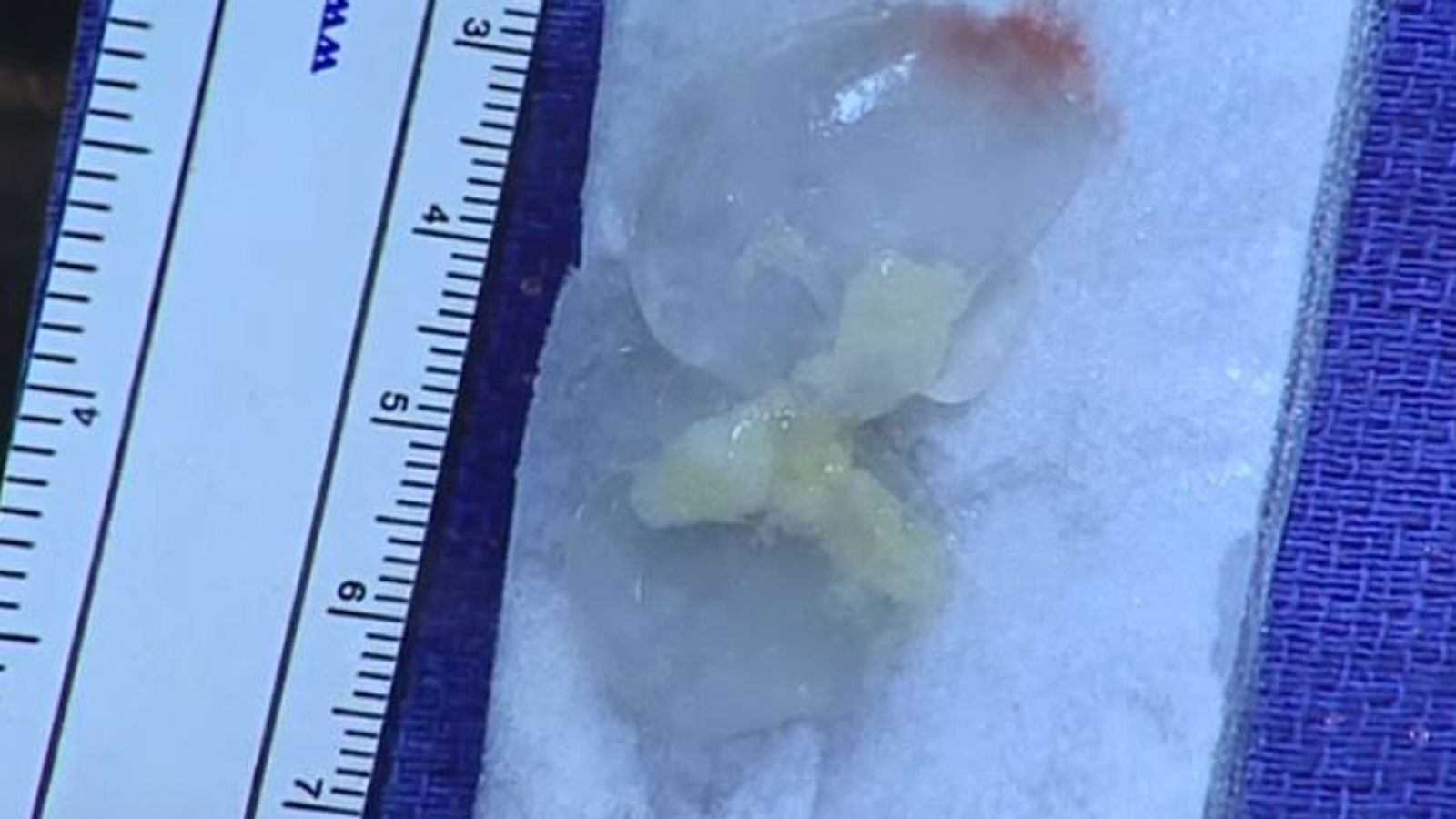 Man whose headaches made him vomit 'had tapeworm in brain for 10 years