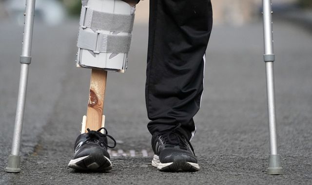 Coronavirus: Amputee's wife makes him wooden leg after COVID-19 crisis delays treatment