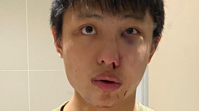 Jonathan Mok said he may need reconstructive surgery 
