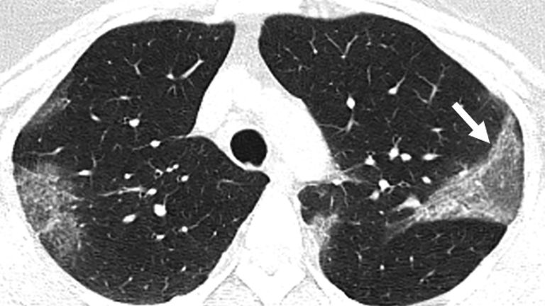 A large section of lung (right in image) displays opacity. Pic: RNAS