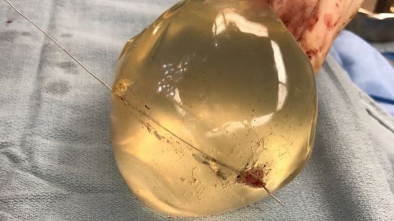 View of left breast implant showing bullet trajectory through implant