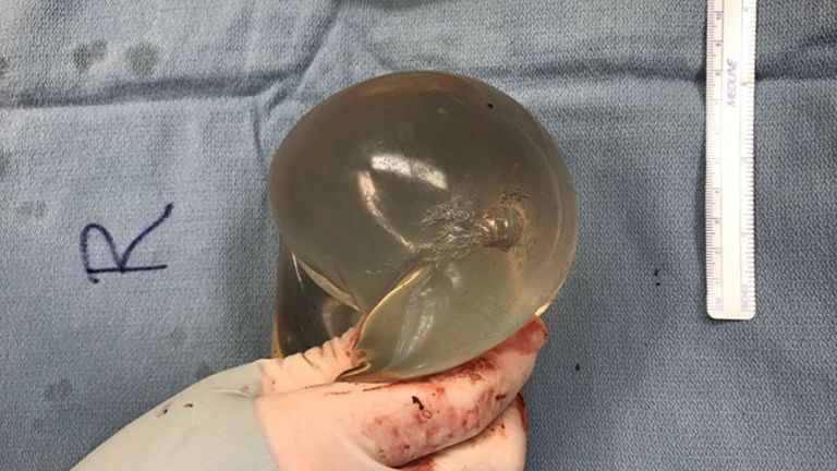View of right breast implant with damage from bullet trajectory