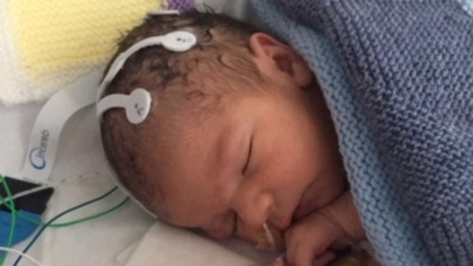 British baby is world's first to get cannabisderived medicine to