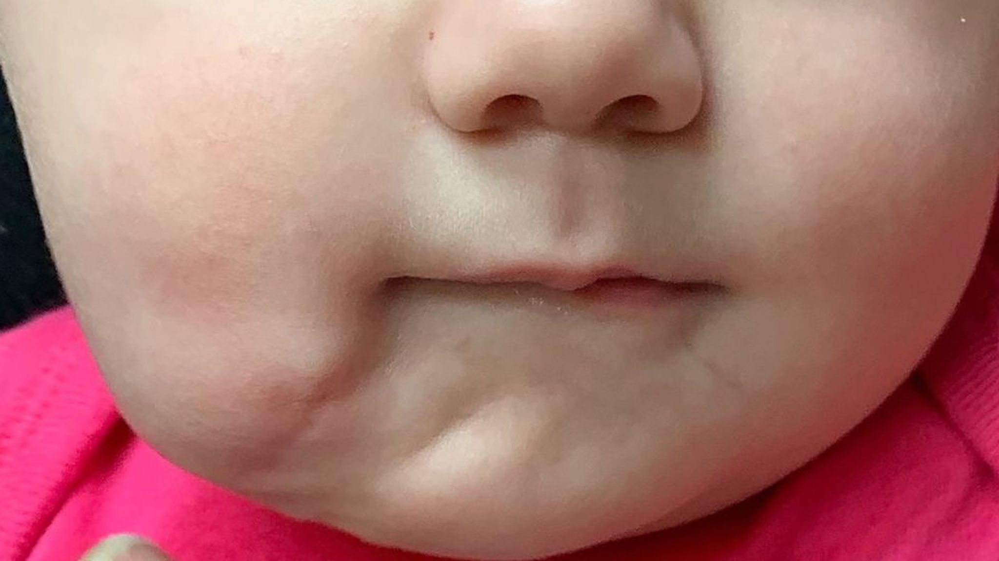 Носогубный треугольник у ребенка. Цианоз носогубного треугольника у ребенка. Посинел подбородок у ребенка. Посинел подбородок у ребенка. Синий носогубный треугольник.