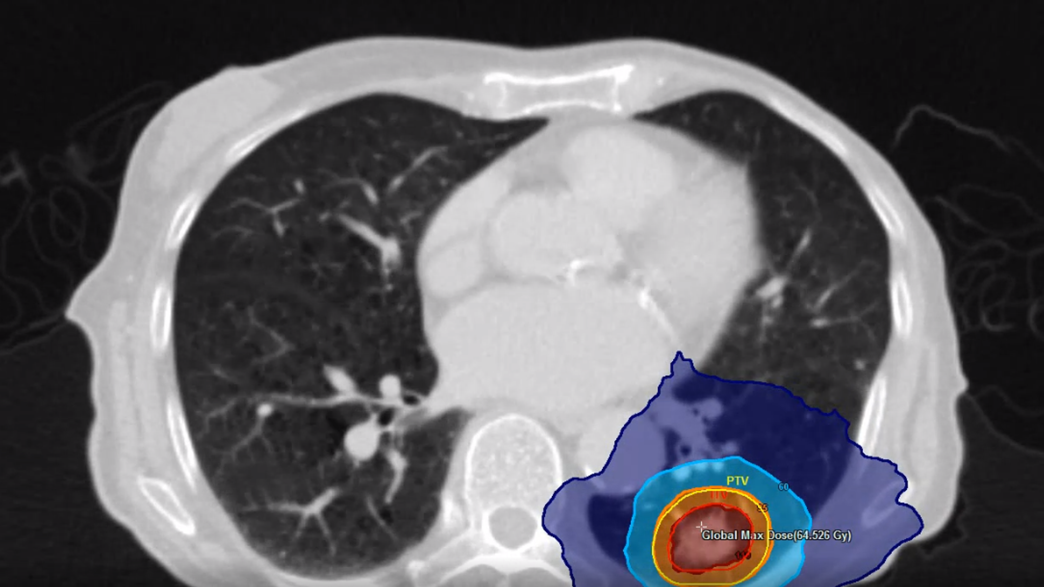 James Cook Radiotherapy 'Life-saving' cancer treatment to be made available at all cancer ...