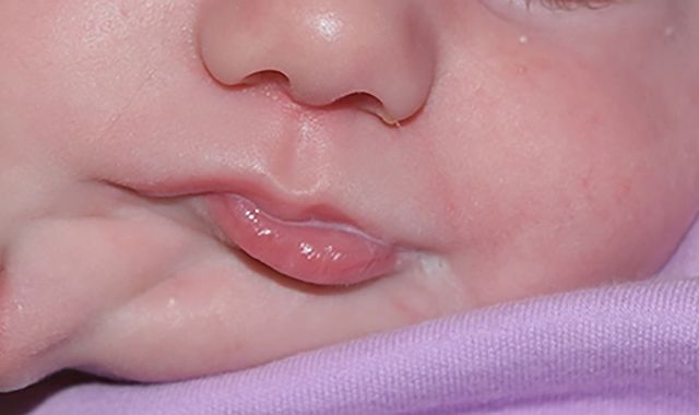 Baby born with two mouths due to 'extremely rare' condition