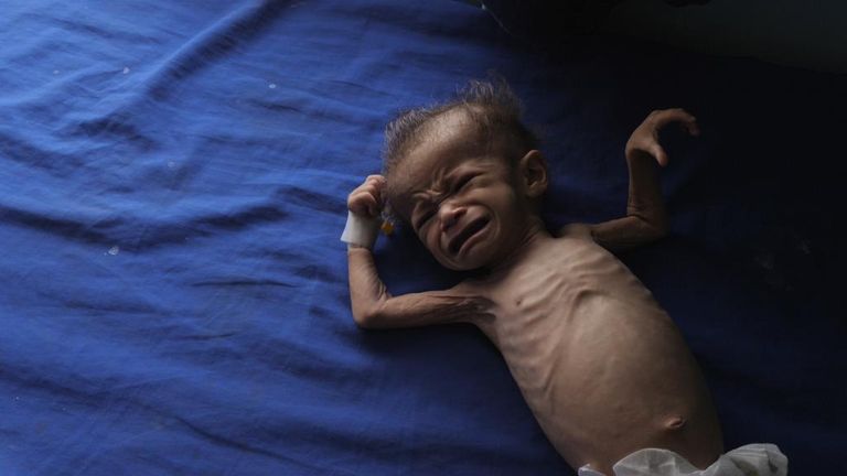 Yemen: Emaciated baby, generic