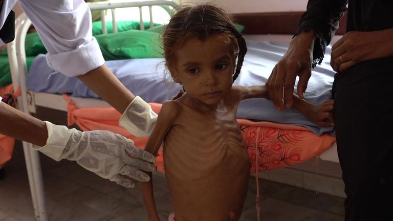 Yemen: Emaciated child receives treatment at hospital in Taiz