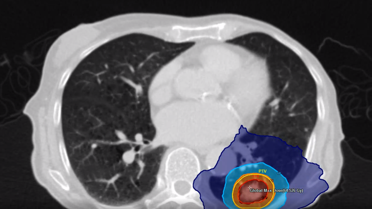 A 4D scan of a tumour with the radiotherapy dose plan. Pic: James Cook University Hospital/Jim Daniel