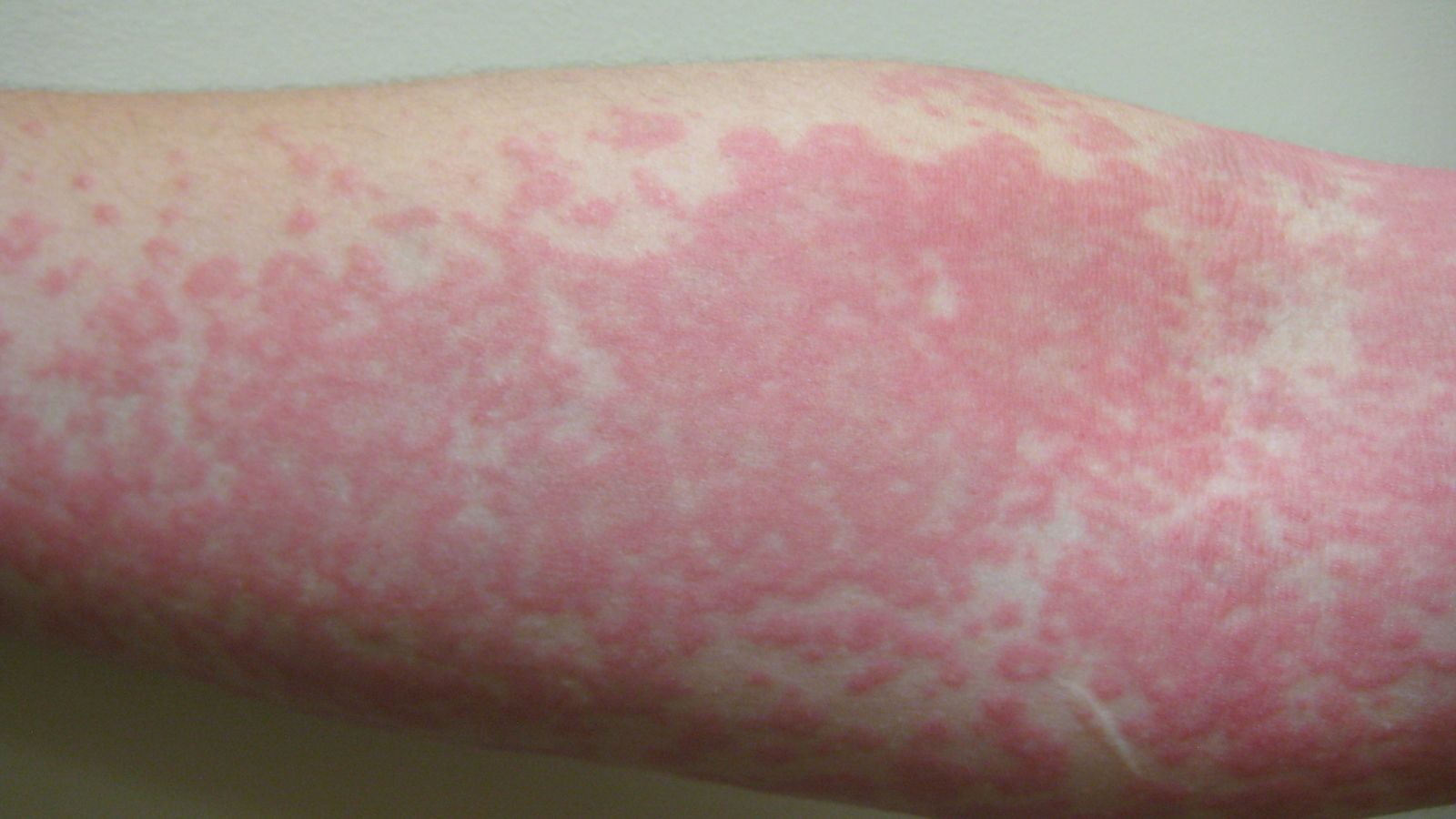 Coronavirus Skin Rash Can Be Only COVID 19 Symptom And Should Be 