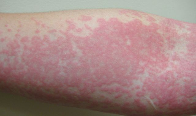 Coronavirus: Skin rash can be only COVID-19 symptom and should be fourth key sign, study finds