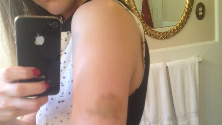 A photograph showing Heard&#39;s bruised arm after an alleged incident in March 2013


