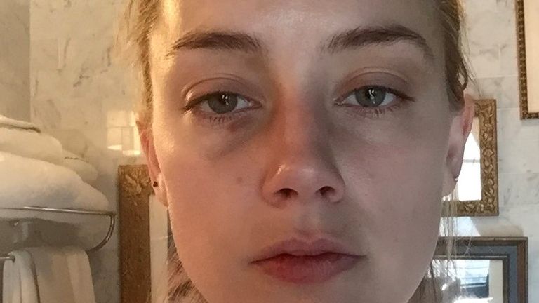 Photos of Amber Heard with bruises were shown in court on day three