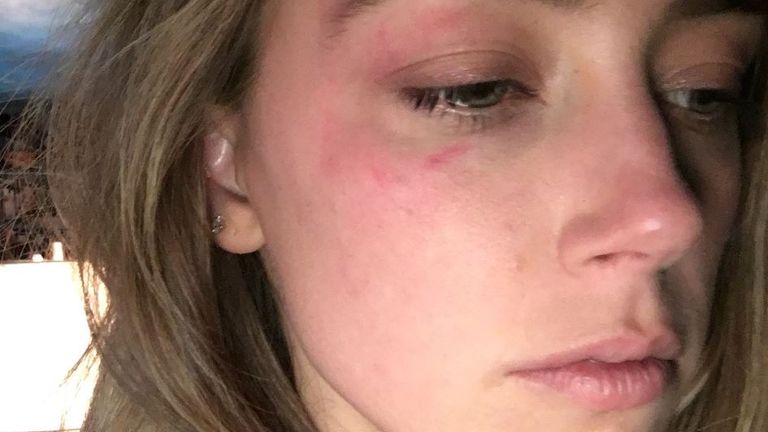 The High Court was shown this picture of Amber Heard&#39;s alleged injuries following an incident in May 2016