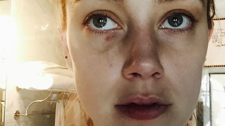 Amber Heard&#39;s alleged injuries from the &#39;headbutt&#39; incident in December 2015