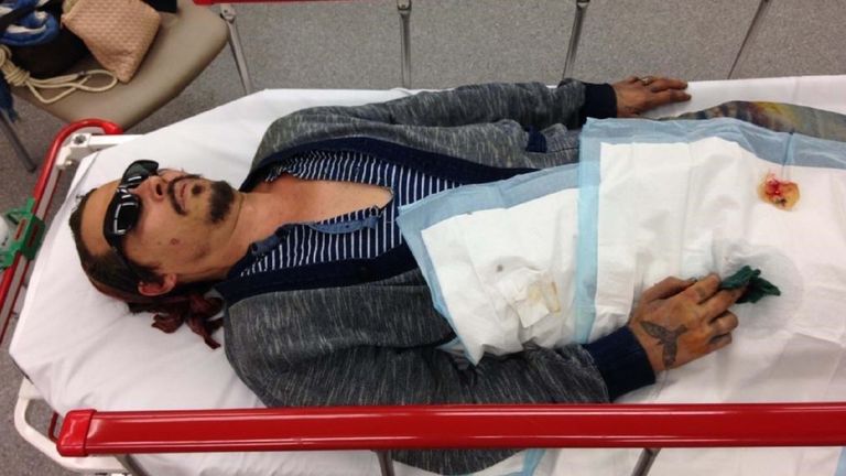 A picture from Johnny Depp&#39;s lawyers show him in hospital after Amber Heard allegedly severed his finger with a vodka bottle.