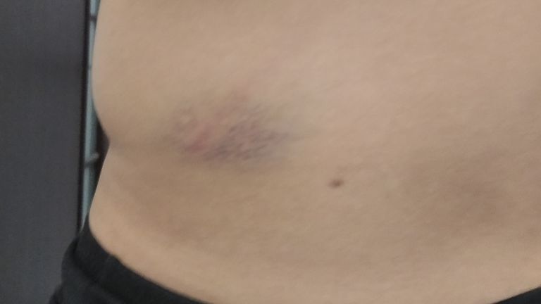 Mr Kviatko had bruising on his back from where police beat him