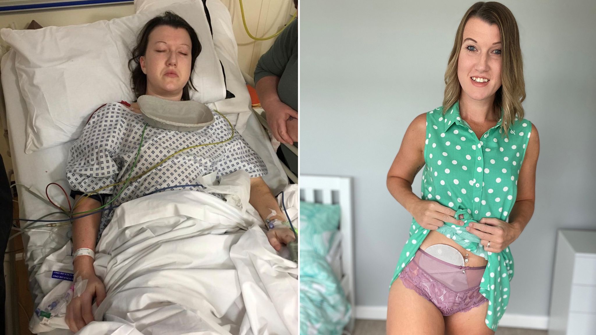 I would rather have died': How getting a stoma bag changed my life