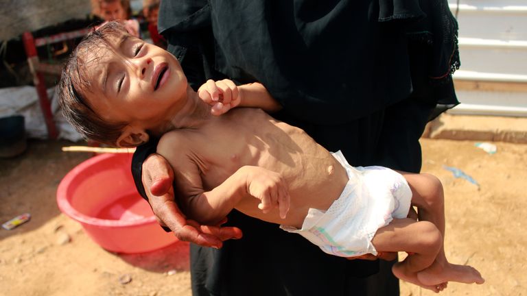 Hashem Mahmoud Atin, a ten-month-old displaced Yemeni child suffering from acute malnutrition and who is unable to reach a hospital for treatment, is held by his mother at a refugee camp in Yemen