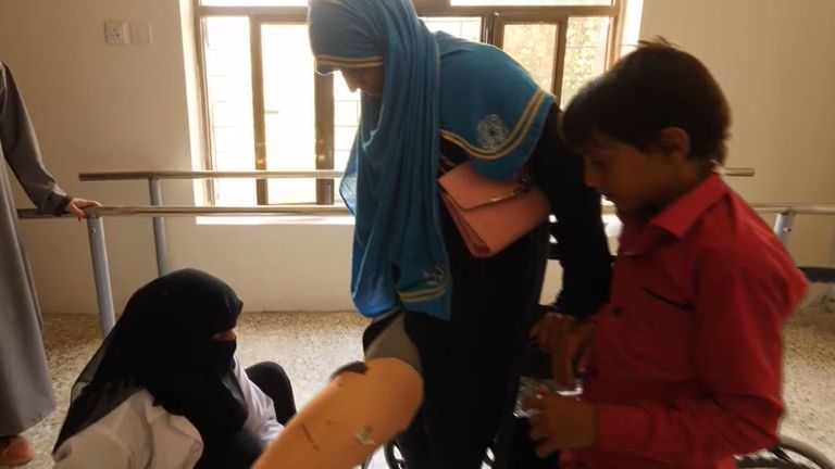 A victim of a mine is fitted with a prosthetic leg in Yemen
