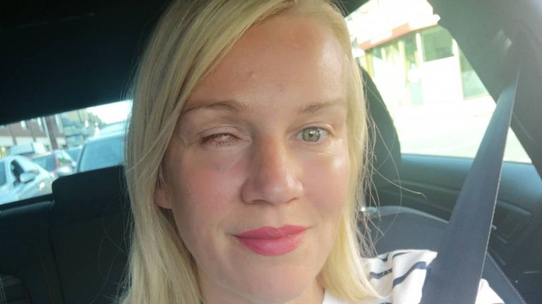 Amber Lewis lost an eye after a firework exploded in her face