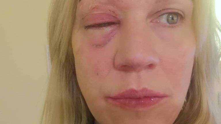 Amber Lewis lost an eye after a firework exploded in her face