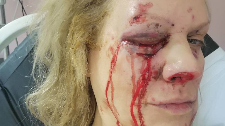 Amber Lewis lost an eye after a firework exploded in her face