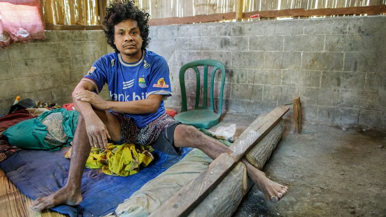 Petrus Roy, a 35-year-old man, has been kept in pasung (shackled) in his family home near Maumere, Flores Island, Indonesia, for 10 years. He is confined in a homemade stock formed out of two thick pieces of wood. This is the traditional method of shackling used in the area.
