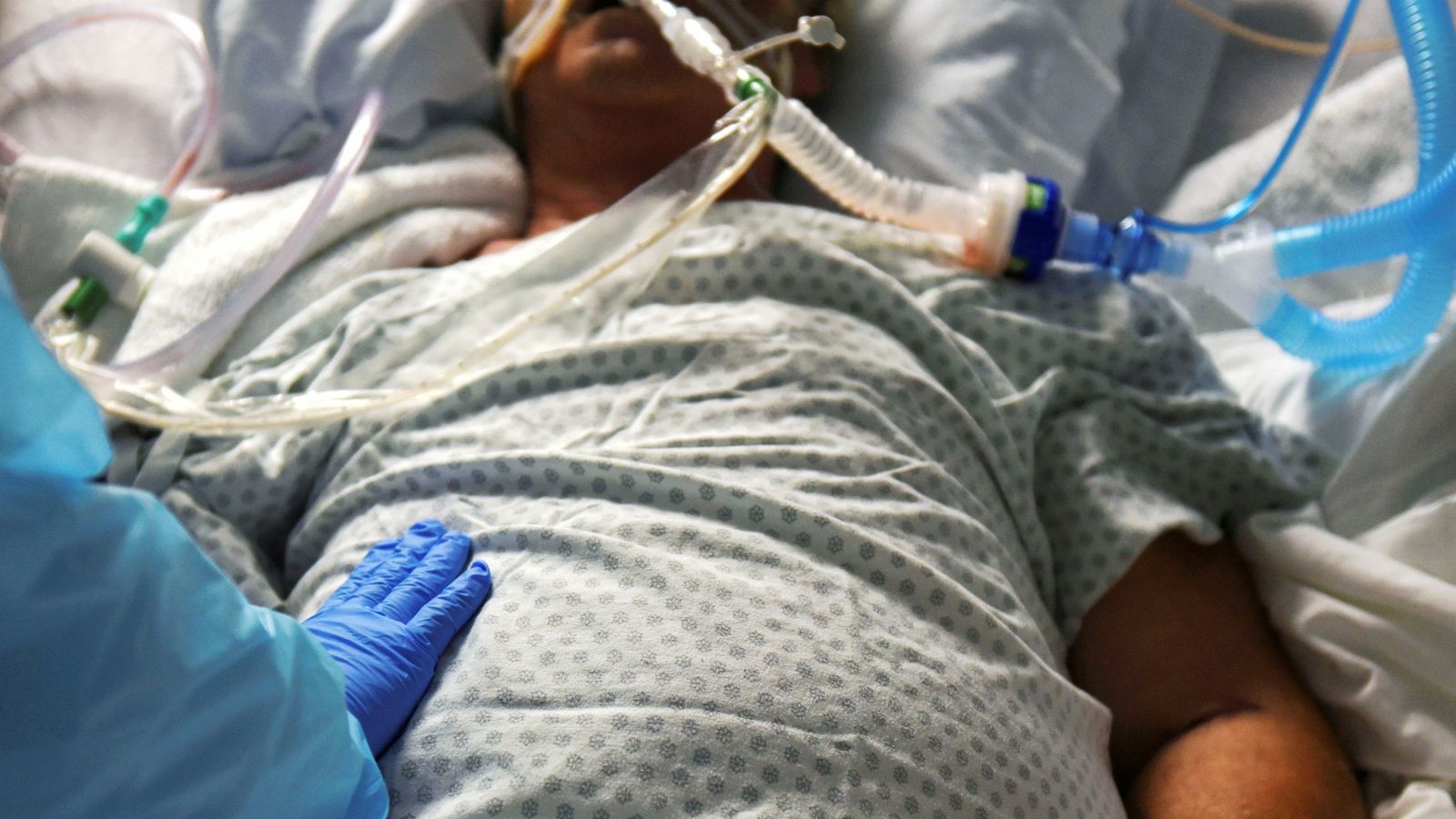 COVID19 New UKdesigned ventilator could mean fewer coronavirus