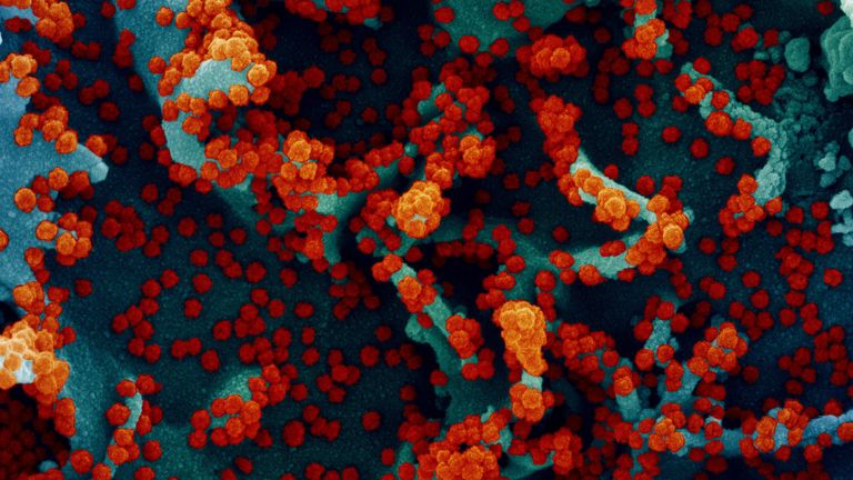 میکروگراف الکترونی روبشی رنگی از یک سلول که به شدت آلوده به ذرات ویروس SARS-CoV-2 (قرمز) است ، جدا شده از یک نمونه بیمار.  تصویر گرفته شده در مرکز تحقیقات یکپارچه NIAID (IRF) در فورت دتریک ، مریلند