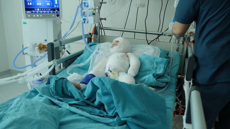 دلال هجده ماهه در آتش سوزی چادر در سوریه دچار سوختگی شدید شد