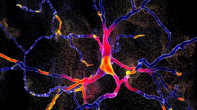 An illustration of the degeneration of dopaminergic neurons, brain cells responsible for voluntary movement and behavioural processes such as mood Pic: Kateryna Kon via Shuttercock