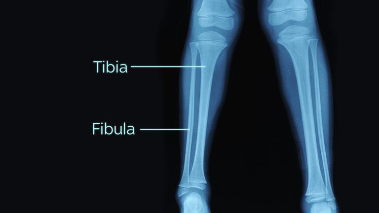 Woods&#39;s open fractures affect both the upper and lower portions of the tibia and fibula bones. File pic