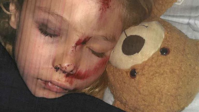 جیمی اسمیت شش ساله پس از اصابت به موتور سوار اسکوتر ، دچار شکستگی جمجمه شد.  عکس: پلیس لسترشر
