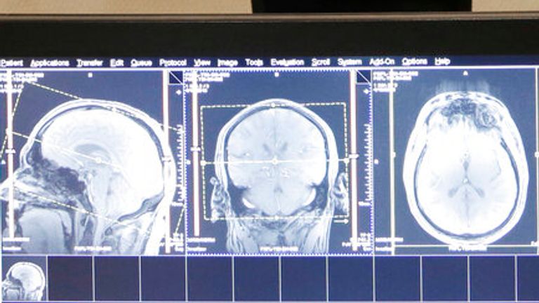 This photo taken April 19, 2013 shows former Detroit Lions quarterback Eric Hipple undergoes an MRI on his brain in Detroit. Months before the NFL and former football players agreed to settle their concussion-related lawsuits, a Detroit-based neurologist began what he calls a "landmark study" on the brains of 50 former players. (AP Photo/Paul Sancya)


