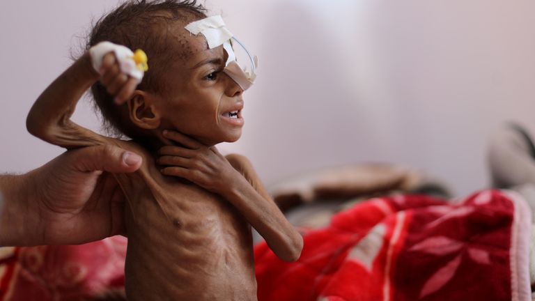 A malnourished girl at a hospital in Sanaa in October 2020