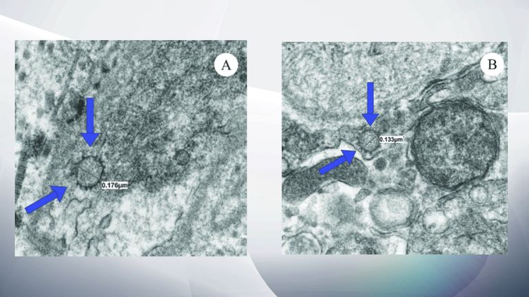بقایای ویروس در بافت آلت تناسلی مرد پیدا شد ، همانطور که با فلش های آبی نشان داده شده است.  عکس: دکتر رنجیت رامزامی / سیستم بهداشت دانشگاه میامی