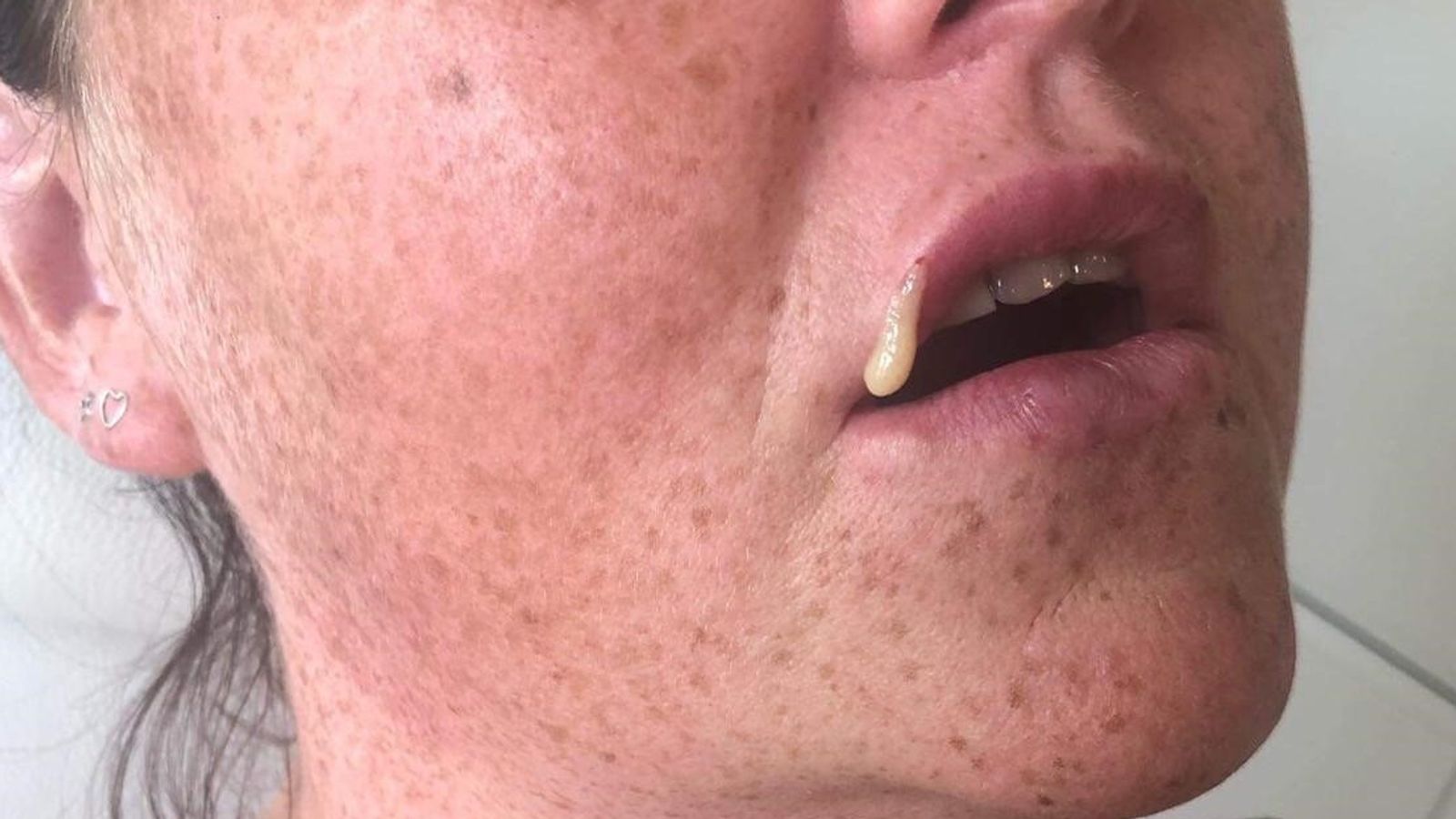 Fillers, false advertising and intimidation The ugly side of the