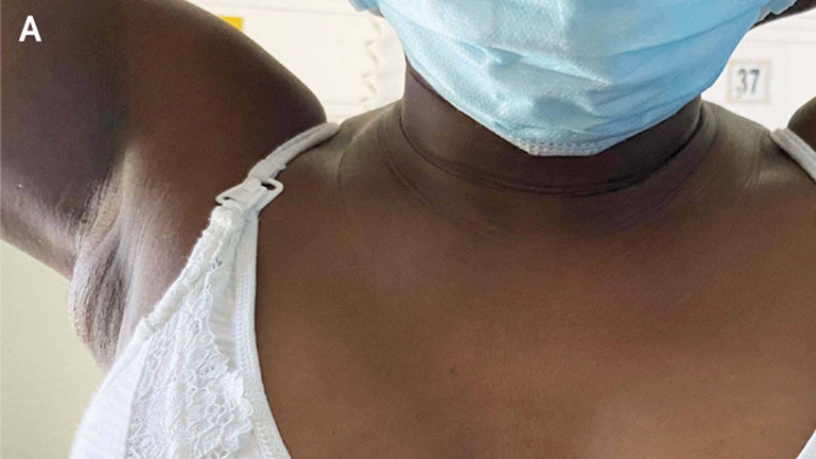 Doctors figure out why woman was lactating from her armpit