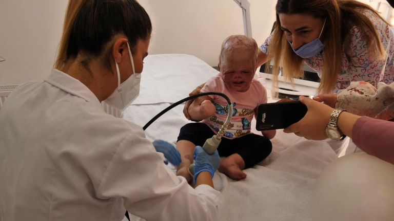A terribly burned Syrian toddler has finally been reunited with her mother and siblings six months after being rushed to Turkey for emergency medical treatment.