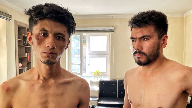 Taqi Daryabi and Nematullah Nadqi show their injuries